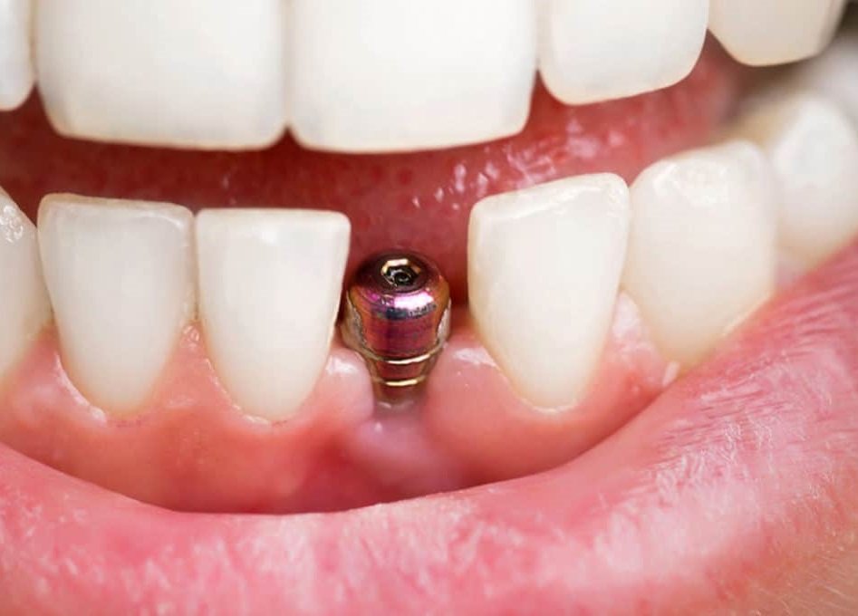 Dental Implants