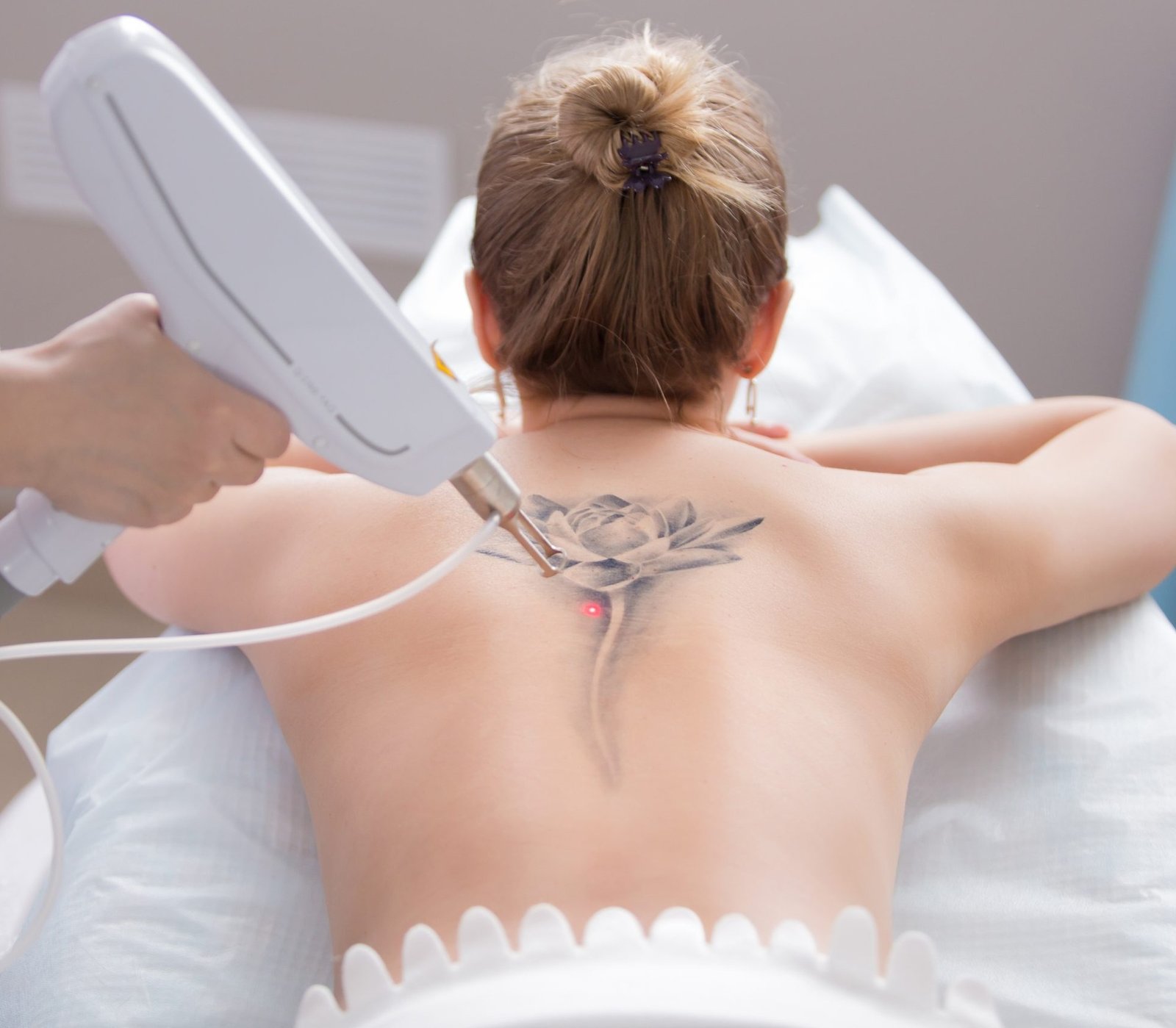Laser Tattoo Removal One Scaled