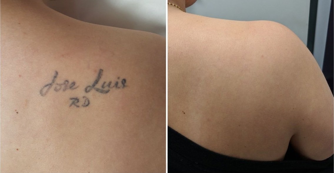Laser Tattoo Removal Results