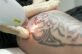 Laser Tattoo Removal from Arm