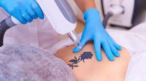 Best Laser Tattoo Removal